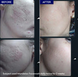 Jenpharm - MandelAC Facewash Anti-Acne Face Wash with 3% Mandelic Acid